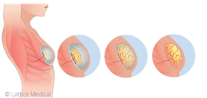 - Principe de fonctionnement de MATTISSE (Régénération du tissu adipeux puis résorption de l'implant)